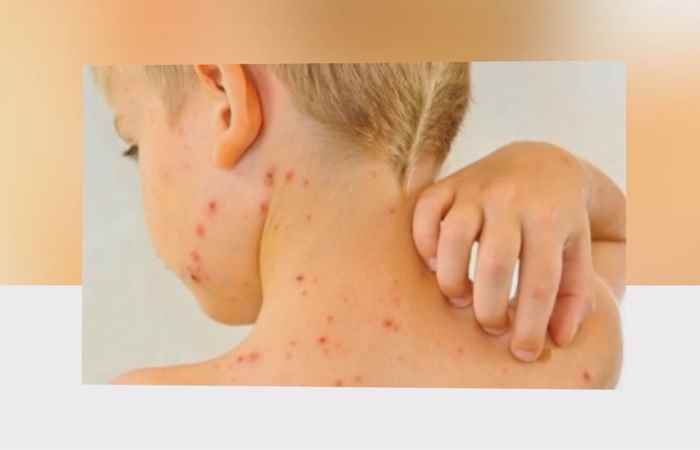 Sống khỏe 360 - Những điều cần biết về tiêm vacxin phòng sởi  01-02-2020